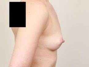 before breast augmentation right side view case 1926