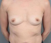 before breast augmentation front view case 1933