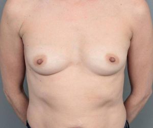 before breast augmentation front view case 1933