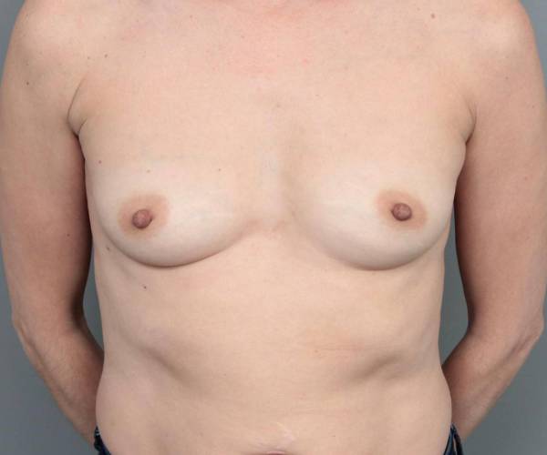 before breast augmentation front view case 1933