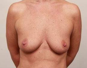 before breast augmentation front view case 1947