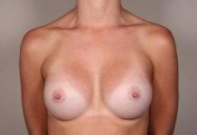 After Breast Augmentation Female Patient Front Angle View Case 1997