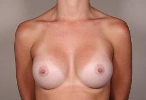After Breast Augmentation Female Patient Front Angle View Case 1997