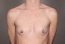 Before Breast Augmentation Female Patient Front Angle View Case 1997