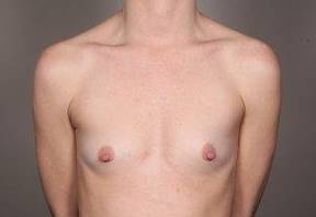 Before Breast Augmentation Female Patient Front Angle View Case 1997