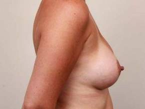 After Breast Augmentation Female Patient Side Angle View Case 2011