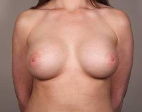 After Breast Augmentation Female Patient Front Angle View Case 2032