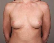 Before Breast Augmentation Female Patient Front Angle View Case 2032