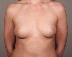 Before Breast Augmentation Female Patient Front Angle View Case 2032