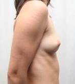 before breast augmentation right side view case 2473