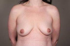 before breast augmentation front view case 2506