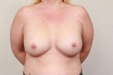 after breast augmentation front view case 2534