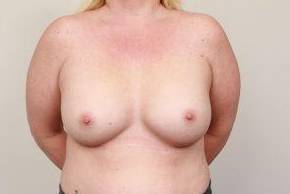 after breast augmentation front view case 2534
