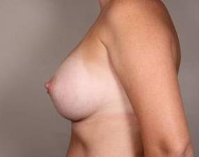 after breast augmentation left side view case 2620