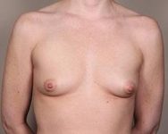 before breast augmentation front view case 2631