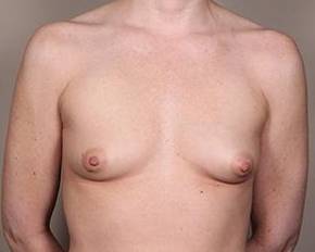 before breast augmentation front view case 2631