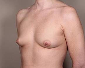before breast augmentation left angled view case 2631