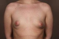 before breast augmentation front view case 2643