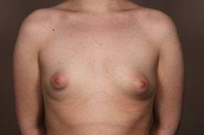 before breast augmentation front view case 2643