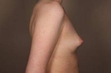 before breast augmentation right side view case 2643