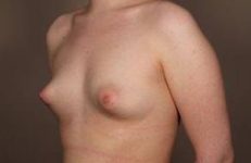 before breast augmentation left angled view case 2643