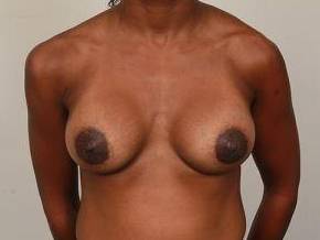 after breast augmentation front view case 2650