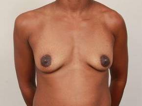 before breast augmentation front view case 2650