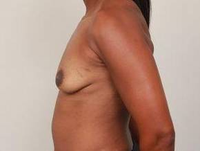 before breast augmentation left side view case 2650