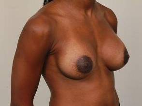 after breast augmentation right angled view case 2650