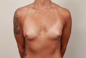 before breast augmentation front view case 2657