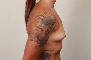 before breast augmentation right side view case 2657