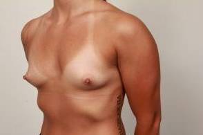 before breast augmentation left angled view case 2657