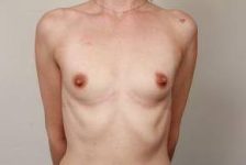 before breast augmentation front view case 2664