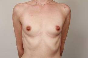 before breast augmentation front view case 2664