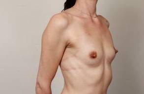 before breast augmentation right angled view case 2664