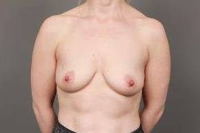 before breast augmentation front view case 2678