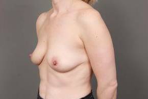 before breast augmentation left angled view case 2678
