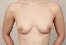 before breast augmentation front view case 2671