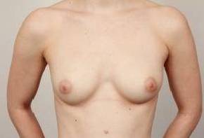 before breast augmentation front view case 2671