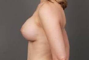 after breast augmentation left side view case 2671