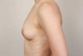 before breast augmentation left side view case 2671