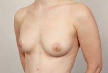before breast augmentation left angled view case 2671