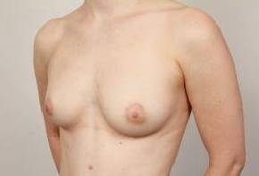 before breast augmentation left angled view case 2671