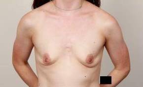 before breast augmentation front view case 2683