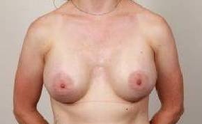 after breast augmentation front view case 2683