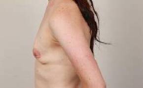 before breast augmentation left side view case 2683
