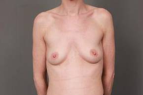 before breast augmentation front view case 2700