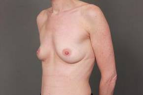 before breast augmentation left angled view case 2700