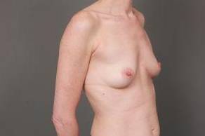 before breast augmentation right angled view case 2700