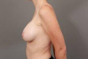 after breast augmentation left side view case 2707